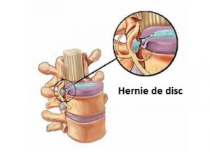 hernie de disc