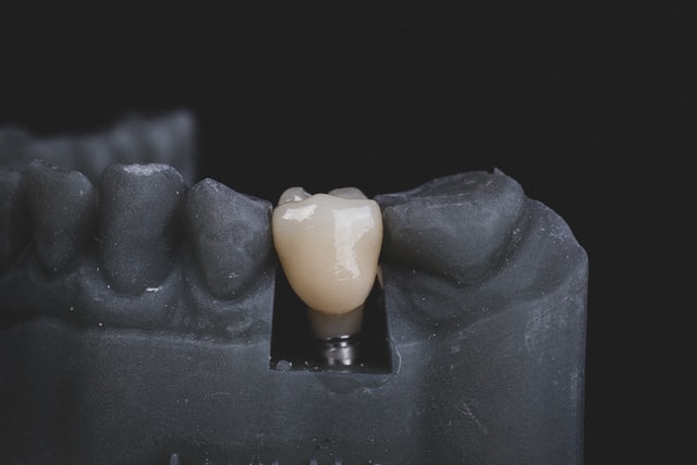implant dentar Bucuresti arata
